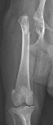無菌性大腿骨頭壊死症