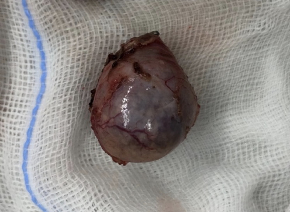 手術にて摘出した副腎腫瘍