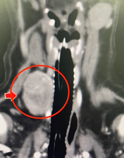 CT検査にて認められた甲状腺腫瘍