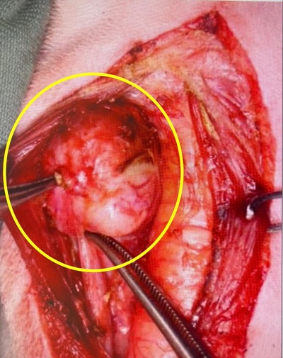 甲状腺腫瘍の摘出手術