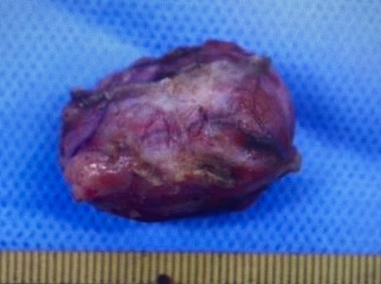 手術により摘出した甲状腺腫瘍
